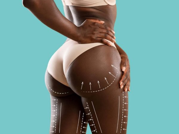 Harmonizacao-de-gluteos